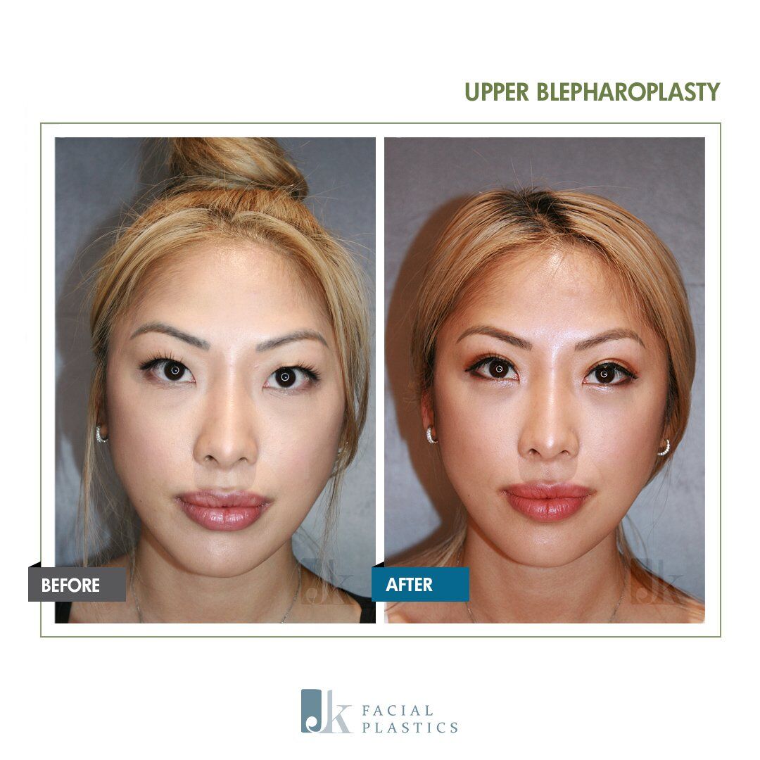 Asian blepharoplasty nyc discount