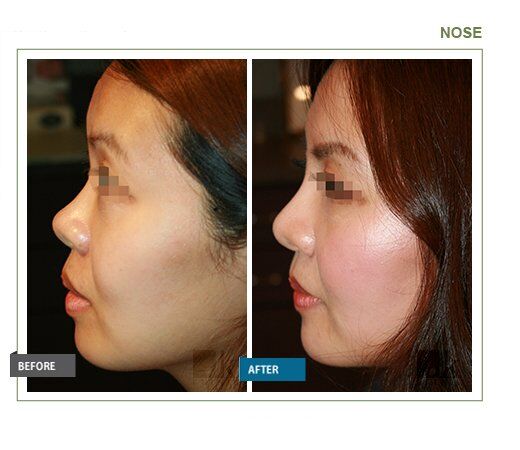 Nose Rhinoplasty 基本技術と臨床ケース JKclinic_nose_002.jpg