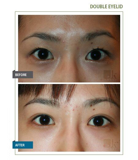 JKclinic_Eye_double_eyelid_02.jpg
