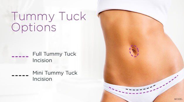 lipo on c section pouch C-Section Overhang Explained: Causes, Risks & Solutions Why do I have a